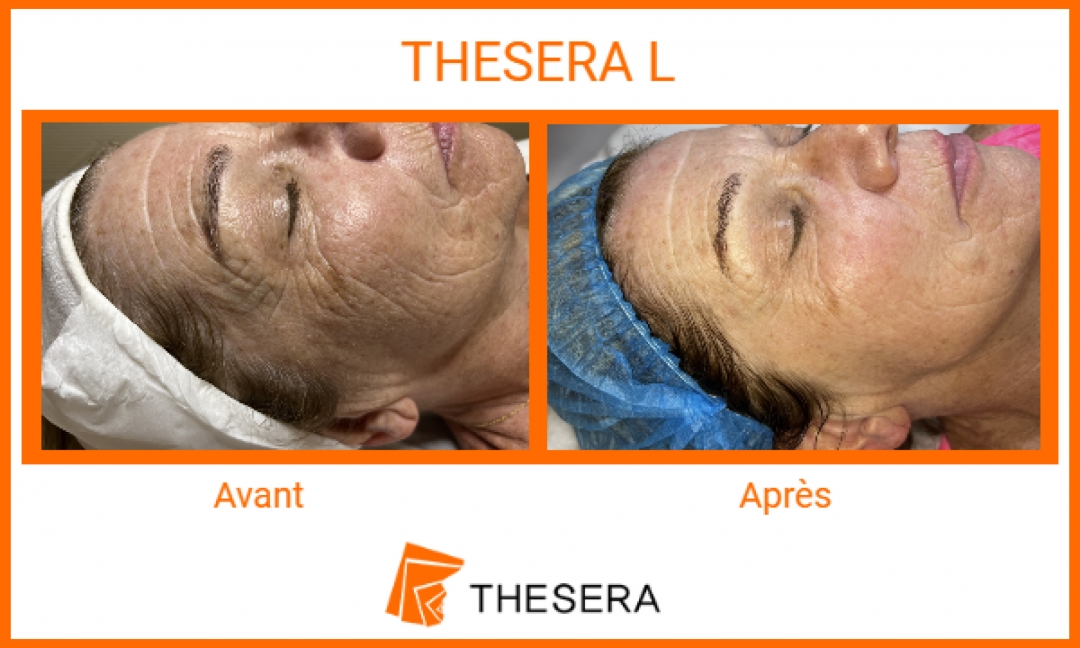 soins thesera avant-après